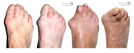 hallux valgus