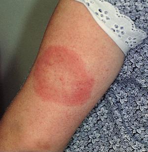 kolobar zaradi klopa pri boreliozi