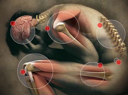 fibromialgia
