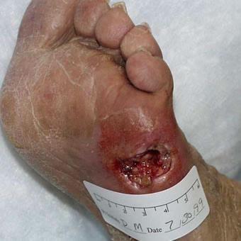 diabeticno-stopalo.JPG