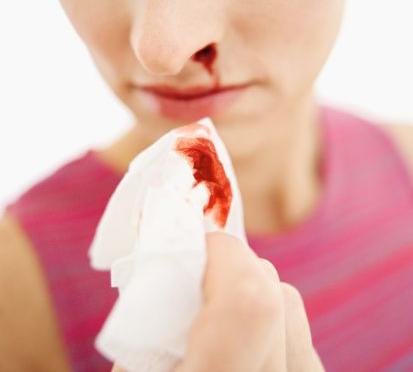 krvavitev-iz-nosu