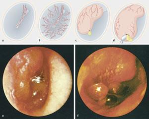 vnetje-srednjega-usesa