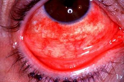 konjuktivitis